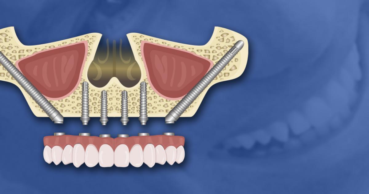 Advantages and Disadvantages of Zygomatic Implants
